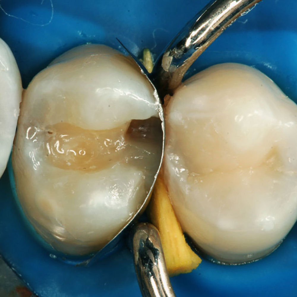 TDV Cales anatomiques